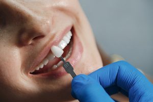 facetas de porcelanas lente de contato dental rj