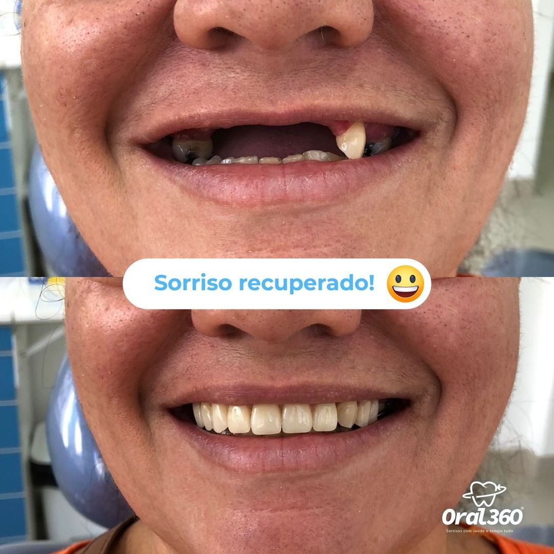 dentista-rj-implantes