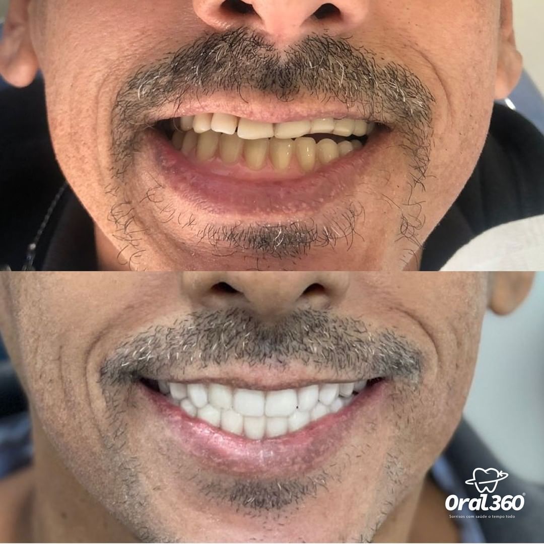 implantes-dentarios-rj-rio
