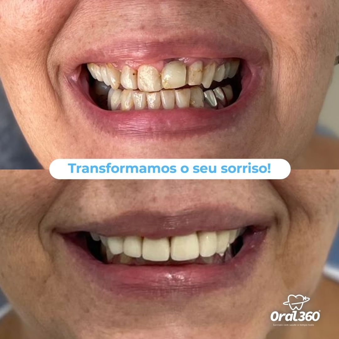 protese-fixa-rj-rio