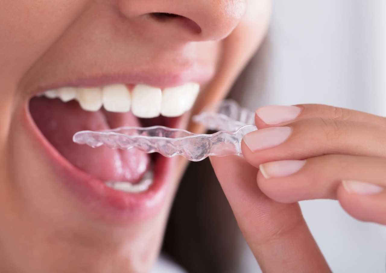 Como funciona o alinhador dental transparente? Alternativa para quem não  quer chamar atenção com o uso do aparelho corretivo. - Dentista em Foz do  Iguaçu - Aparelho Ortodôntico - Facetas - Implantes 