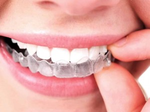 Tudo Sobre Aparelho Ortodôntico - Clínica Odontológica Oral 360